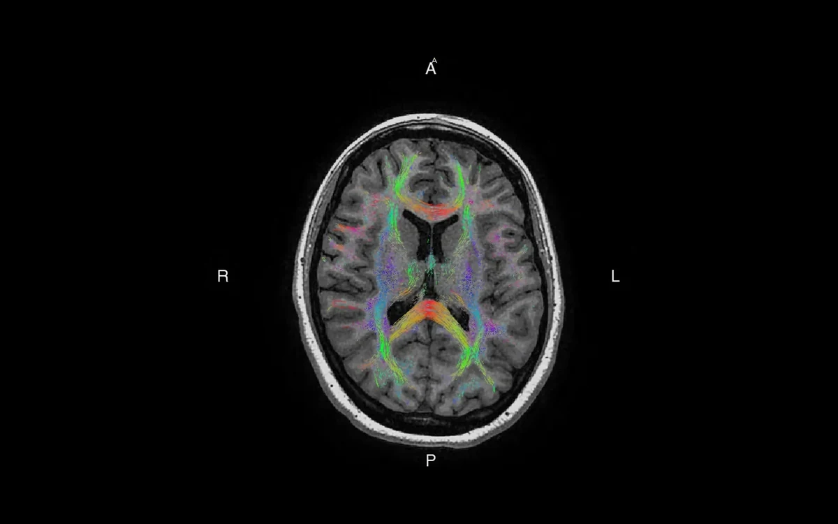 Brain diffusion tensor imaging scan